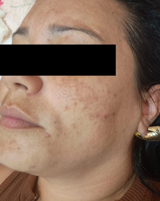 Tratamento de melasma — antes