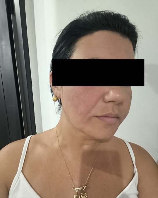 Tratamento de melasma — depois