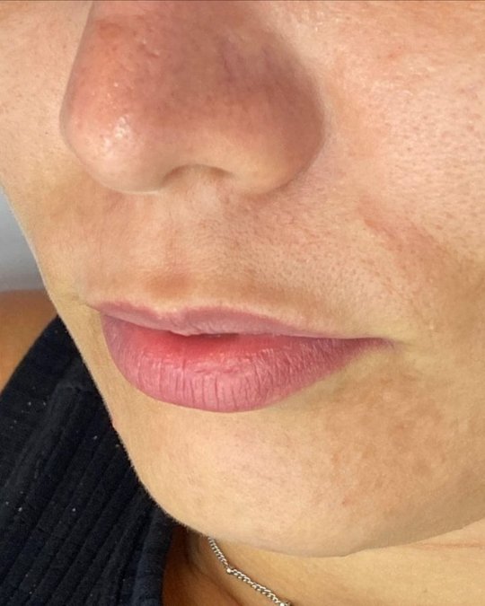 Preenchimento labial — antes