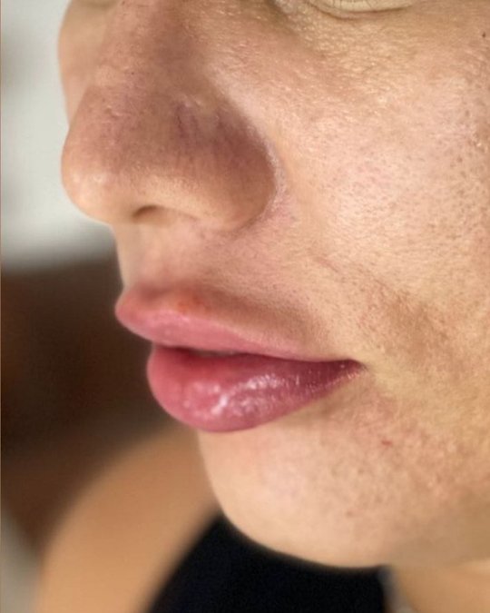 Preenchimento labial — depois