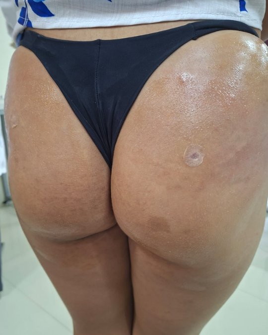 Glúteos Max — depois